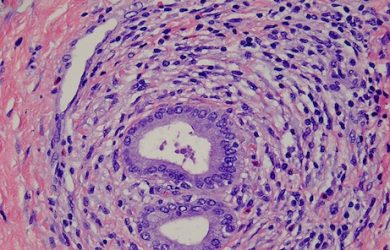 Scientists discover pathways to liver disease