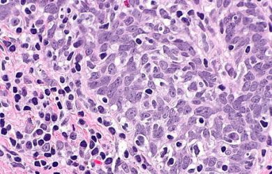 Halting cancer in its tracks