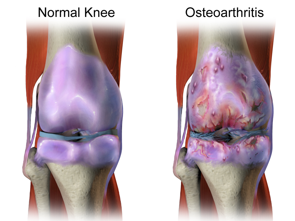 Joint lubricating fluid plays key role in osteoarthritic pain