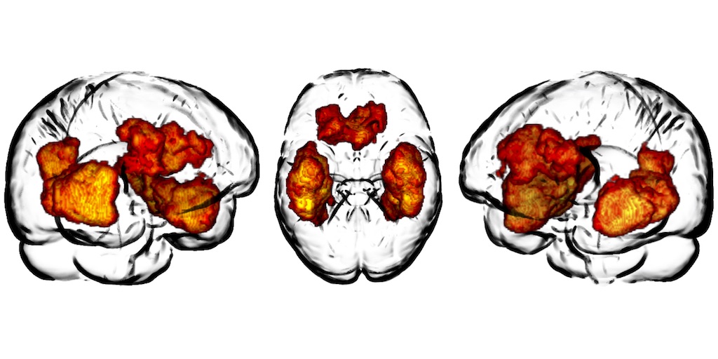 Researchers publish glioma frequency map